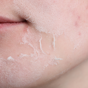 Gia Công Serum Peel Mandelic 20